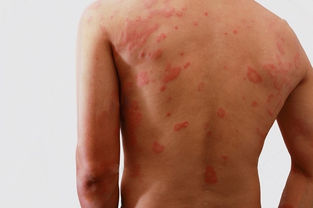 Hanseníase: carreta percorrerá cinco cidade do Piauí fazendo diagnósticos gratuitos