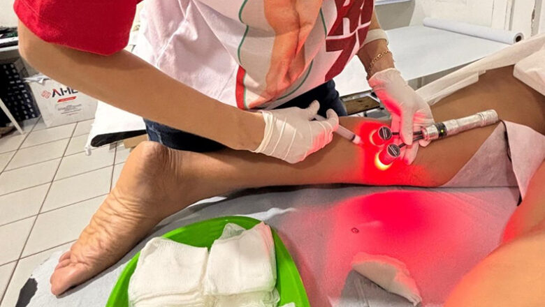 Sesapi divulga cronograma do Programa de tratamento de varizes