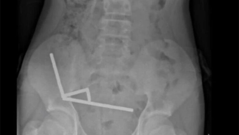 Adolescente perde parte do intestino após engolir cerca de 100 ímãs