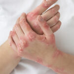 Psoríase ainda é cercada de estigmas e exige diagnóstico precoce