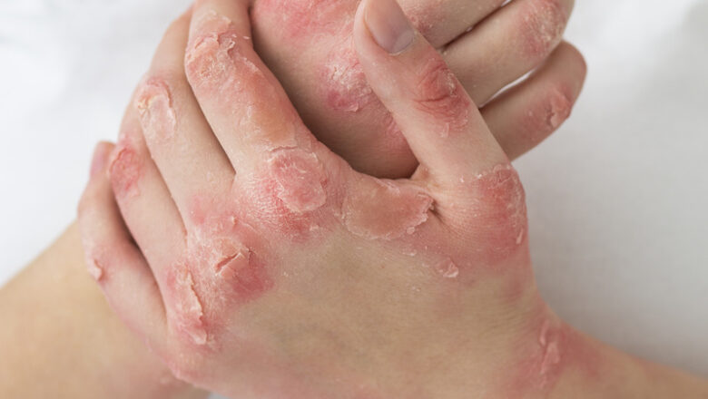 Psoríase ainda é cercada de estigmas e exige diagnóstico precoce