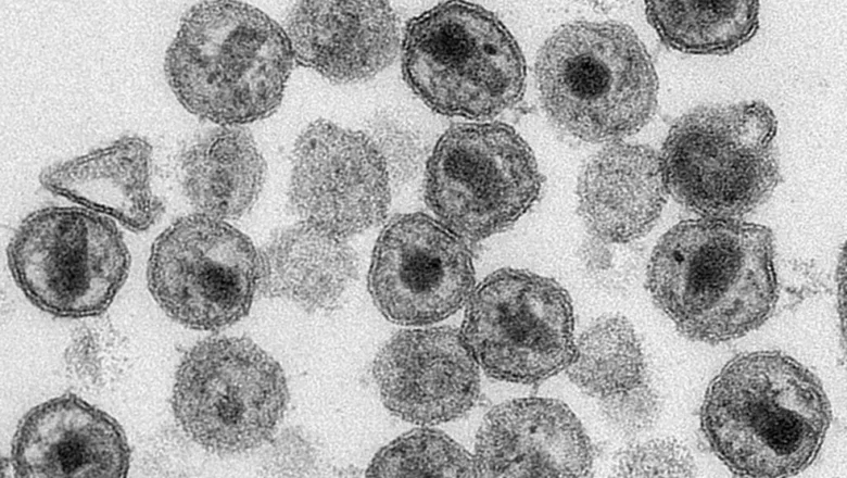 Cientistas descobrem anticorpo eficaz contra o HIV