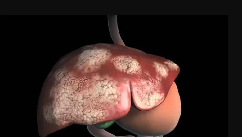 Silencioso e perigoso: o que é o câncer de fígado, como surge e o que fazer para evitar a doença