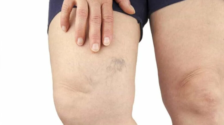 Sofre com varizes? Conheça mitos e verdades sobre a doença