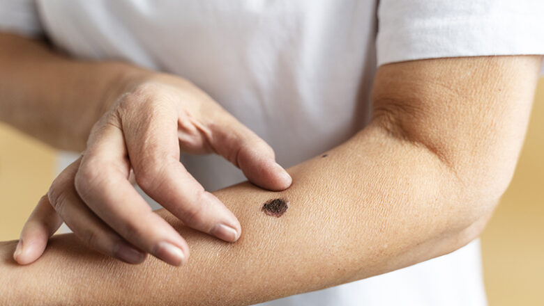 Teresina terá mutirão gratuito para prevenção do câncer de pele neste sábado