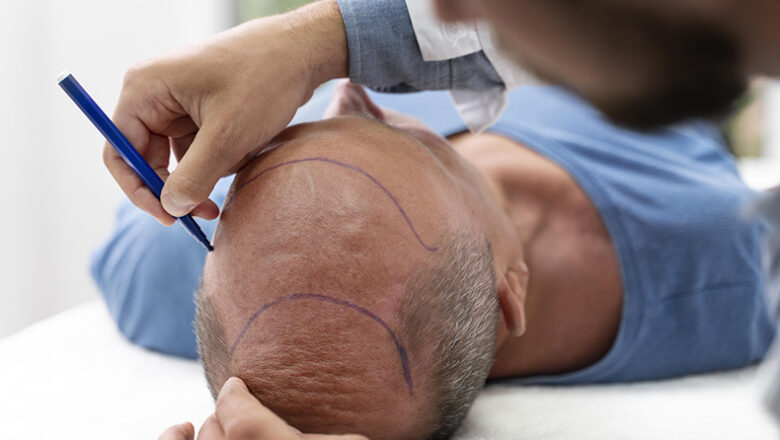 Implante capilar entenda quem pode fazer e como é a recuperação