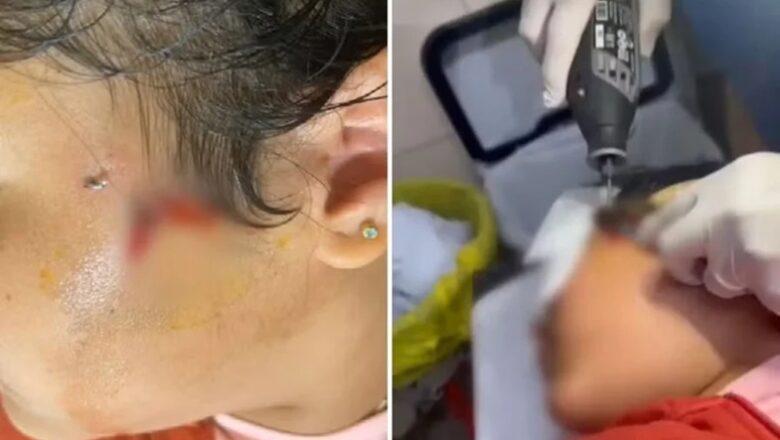 Menina 10 anos fica com anzol preso na bochecha durante pescaria em GO