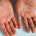 Brasil registra novos casos de Mpox; saiba quais são os estados afetados