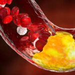 Dois hábitos comuns podem estar prejudicando suas artérias sem que você perceba