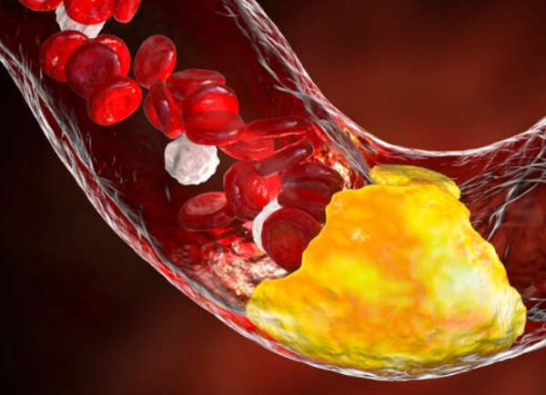 Dois hábitos comuns podem estar prejudicando suas artérias sem que você perceba