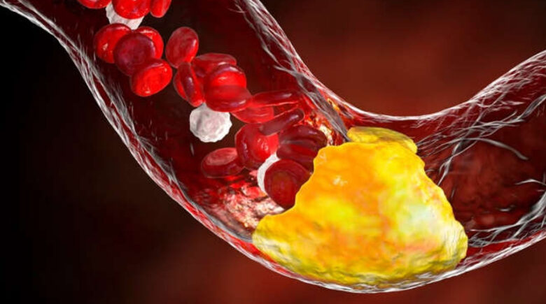 Dois hábitos comuns podem estar prejudicando suas artérias sem que você perceba