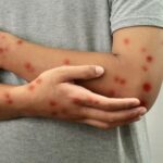 Brasil registra 140 casos confirmados de Mpox em 2026, diz Ministério da Saúde