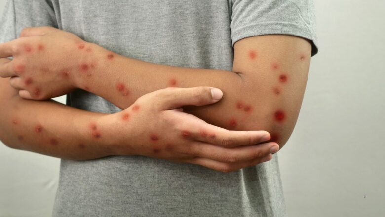 Brasil registra 140 casos confirmados de Mpox em 2026, diz Ministério da Saúde
