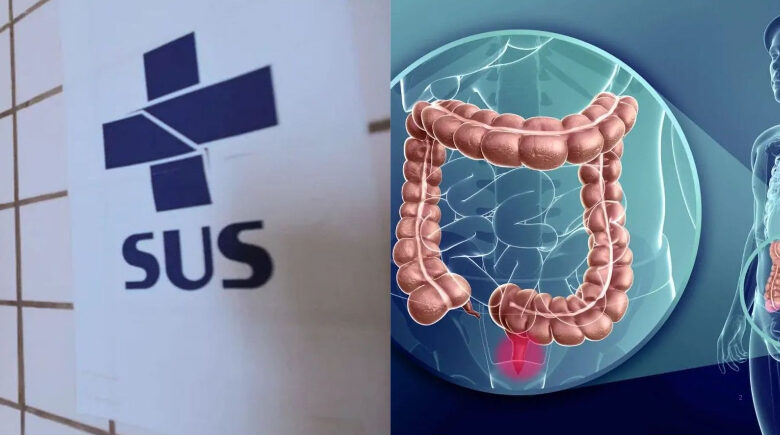 SUS pode implementar programa de rastreamento do câncer colorretal