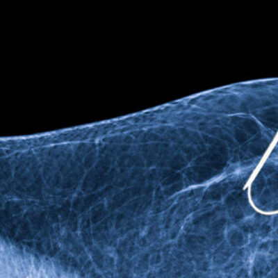 Nova tecnologia promete avanço no combate a casos complexos de câncer