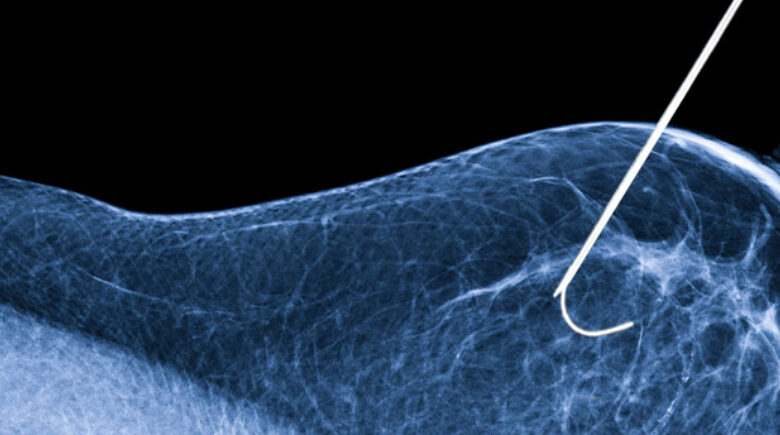 Nova tecnologia promete avanço no combate a casos complexos de câncer