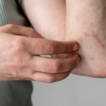 Pessoas com dermatite atópica têm maior risco de depressão e ansiedade