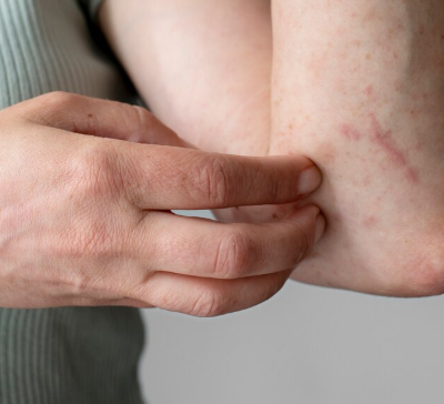 Pessoas com dermatite atópica têm maior risco de depressão e ansiedade