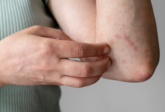 Pessoas com dermatite atópica têm maior risco de depressão e ansiedade